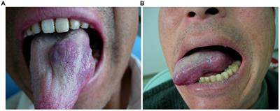 Therapeutic evaluation of electrochemical therapy combined with local injection of pingyangmycin for the treatment of venous malformations in the tongue